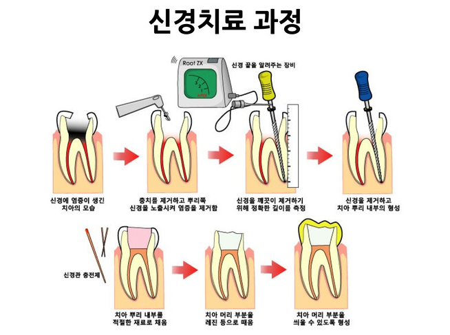 치아 신경치료 과정