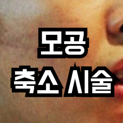 모공 축소 시술