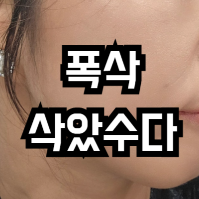 피부과 레이저 시술이 오히려 노화