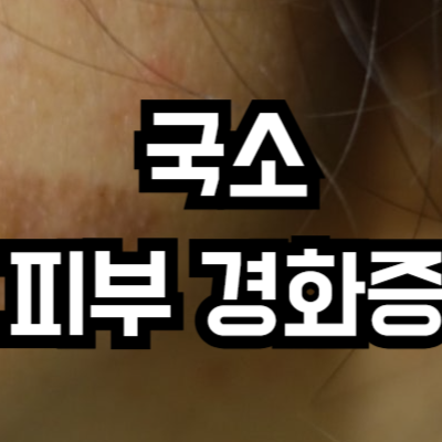 국소 피부 경화증 원인과 증상