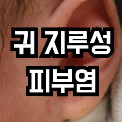 귀 지루성 피부염 비판텐 연고