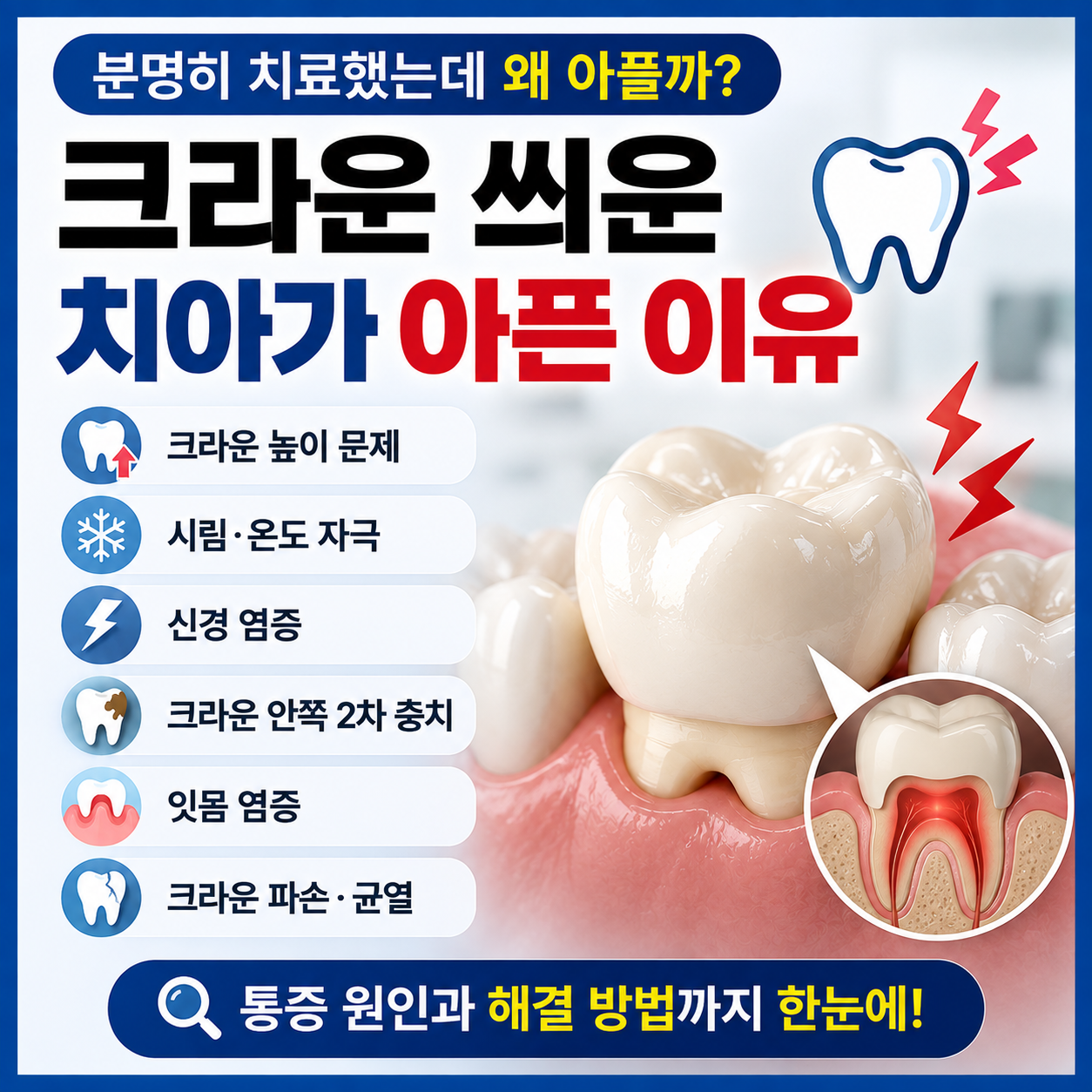 크라운 씌운 치아가 아픈 이유